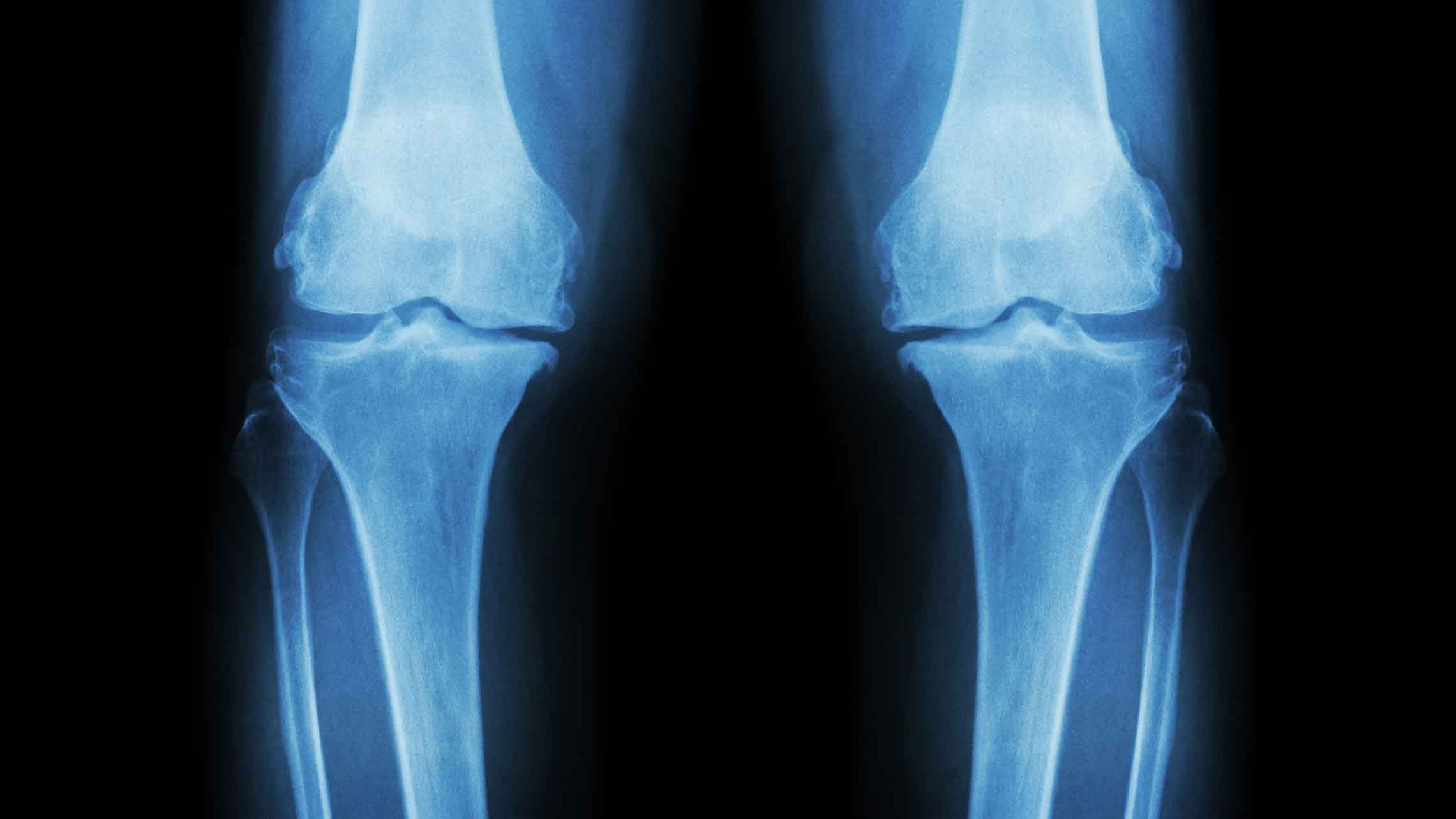 How To Support Bone Health & Prevent Osteoporosis With Correct Nutrition