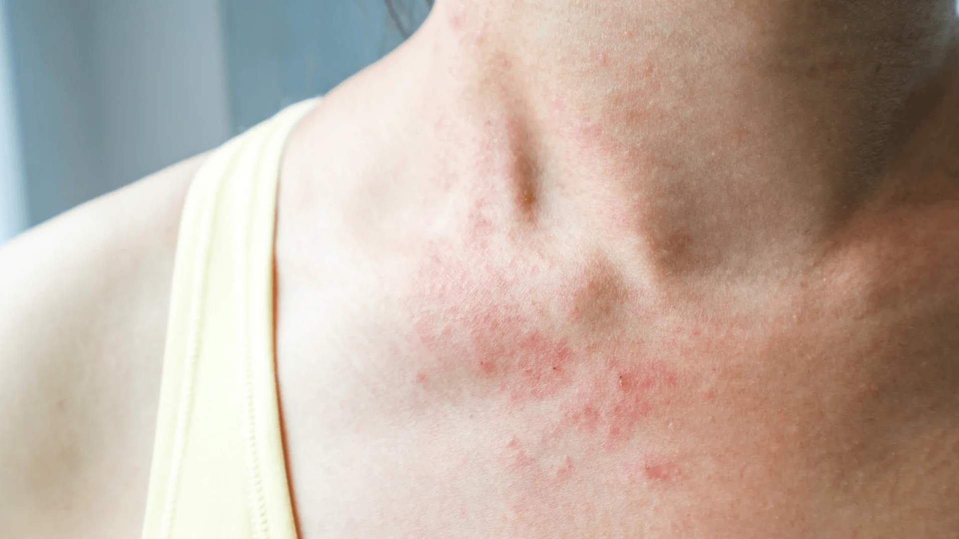 Histamine Intolerance, Gut Health & DAO: A Functional Medicine Guide