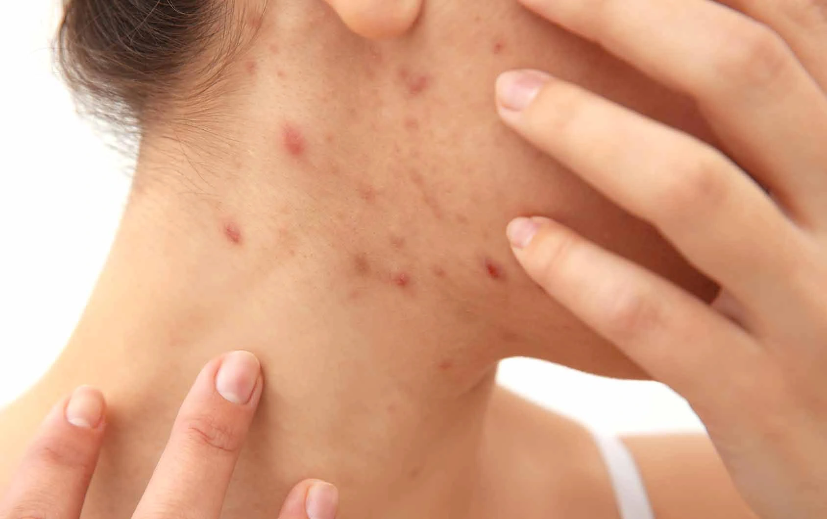 What Really Causes Acne and How to Address the Root Causes